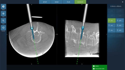 Fusion Robotics Wins FDA Clearance for 3D Imaging Robotic Targeting System | Legacy MedSearch – Medical Device Recruiters