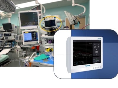 Sensifree Wins CE Certification for SentiCor-100® Continuous Non-Invasive Blood Pressure Monitor