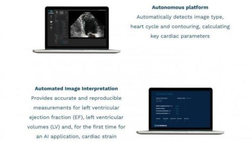 FDA Clears AI-powered Cardiac Echo Analysis and Quantification by Ultromics