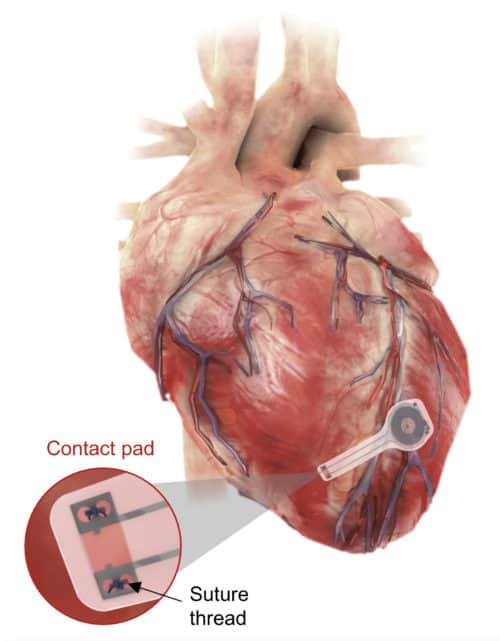 First-ever transient pacemaker harmlessly dissolves in body