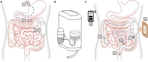An implantable device for delivering insulin that can be refilled by an ingestible capsule