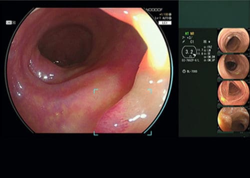 FUJIFILM’s AI Colonic Polyp Detector Cleared in Europe
