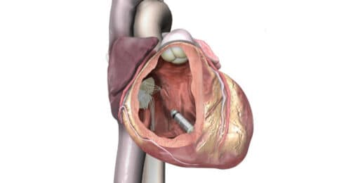 Medtronic Takes Leadless Pacemakers to a New Level