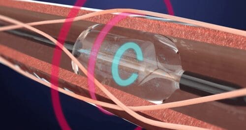 Recor Medical claims first FDA approval in renal denervation for stubbornly high blood pressure.