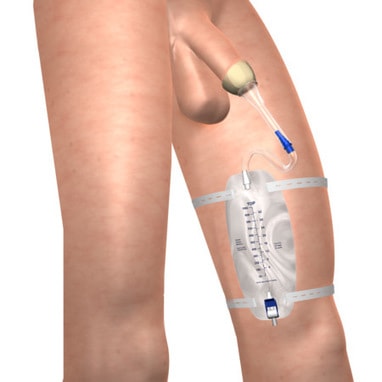 BioDerm® Male Continence Device