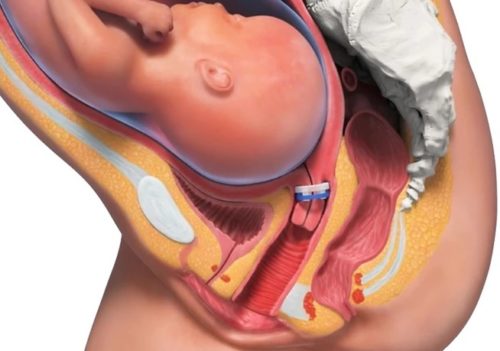 LIONESS Device to Help Prevent Preterm Birth