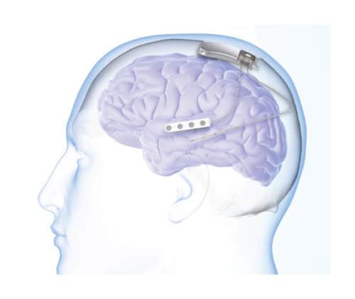 NeuroPace RNS System for Epilepsy Gets FDA Approval for MRI Labeling NeuroPace RNS System for Epilepsy Gets FDA Approval for MRI Labeling