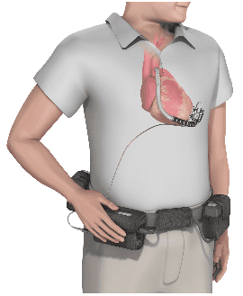 Medtronic Recalls HVAD Pump Implant Kits Due to Delayed or Failed Restart After the Pump is Stopped | FDA Medtronic Recalls HVAD Pump Implant Kits Due to Delayed or Failed Restart After the Pump is Stopped | FDA
