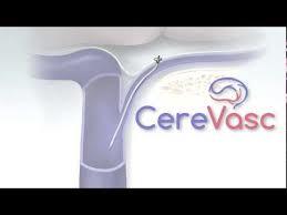 CereVasc Lands $44M for New Medical Device to Drain “Water on the Brain”