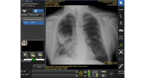 FDA OKs GE Healthcare’s AI-Powered Chest X-ray