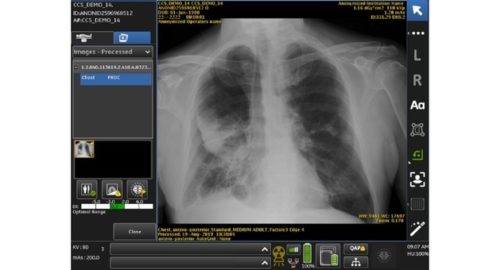 FDA OKs GE Healthcare’s AI-Powered Chest X-ray FDA OKs GE Healthcare’s AI-Powered Chest X-ray
