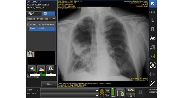 GE Healthcare's AI-Powered Chest X-ray