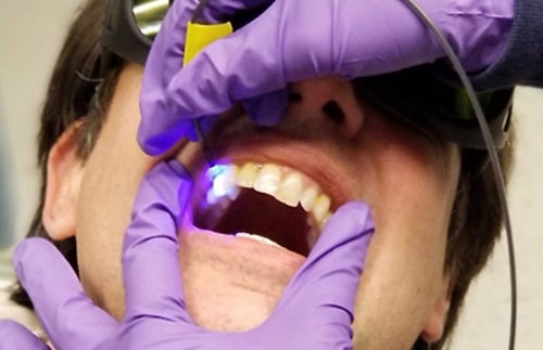 Optical Probe Measures Dental Plaque Acidity | Medgadget