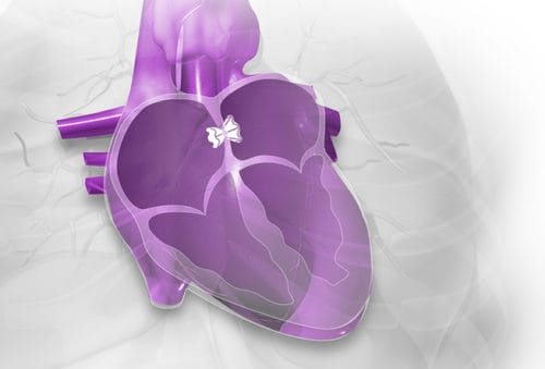 V-Wave Shunt for Relief of Heart Failure Symptoms Cleared in EU