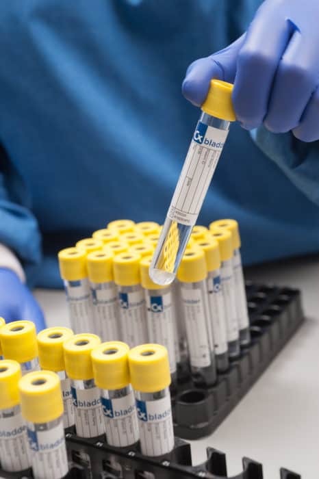 Pacific Edge Diagnostics Receives Medicare Coverage for Bladder Cancer Test