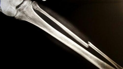 Bone Bolt system for treating complex fractures earns FDA nod