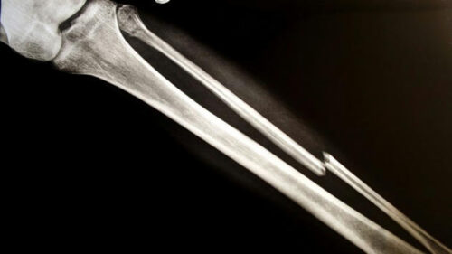Bone Bolt system for treating complex fractures earns FDA nod Bone Bolt system for treating complex fractures earns FDA nod