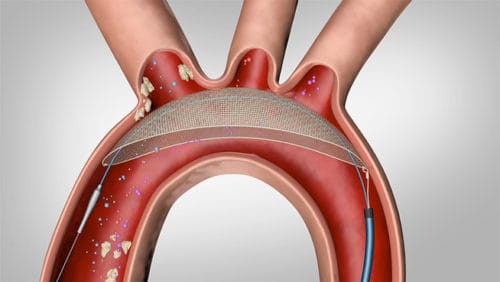 TriGUARD 3 Wins CE Mark for Cerebral Protection During Transcatheter Heart Procedures TriGUARD 3 Wins CE Mark for Cerebral Protection During Transcatheter Heart Procedures