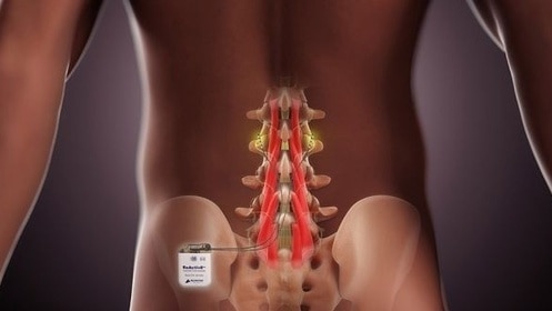 Mainstay Medical gets approval to sell back pain device in US