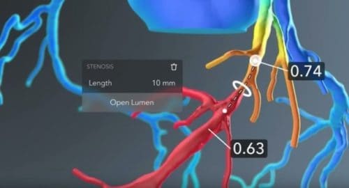 FDA OKs HeartFlow’s Non-Invasive, Real-Time Virtual Modeling Tool For Coronary Artery Disease
